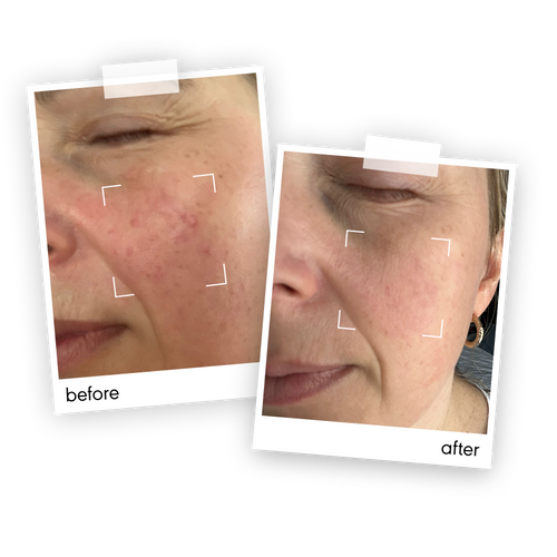 "The rosacea, sensitivity and breakouts I suffered with was completely gone in about 7 days"