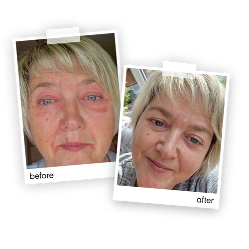 "My skin was so reactive, with nasty flare ups, but has now cleared and I've not suffered since starting using Made Of More Rescue Balm."